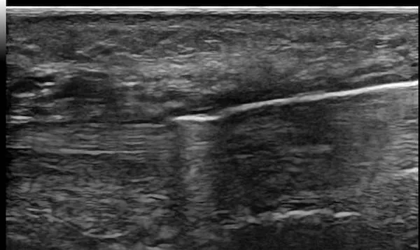 Echo chirurgie canal carpien chirurgie canal carpien