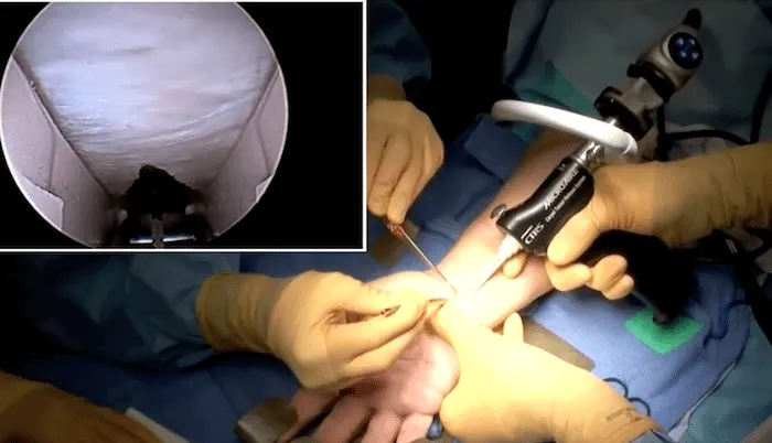Chirurgie du canal carpien par voie endoscopique Chirurgie du canal carpien par voie endoscopique